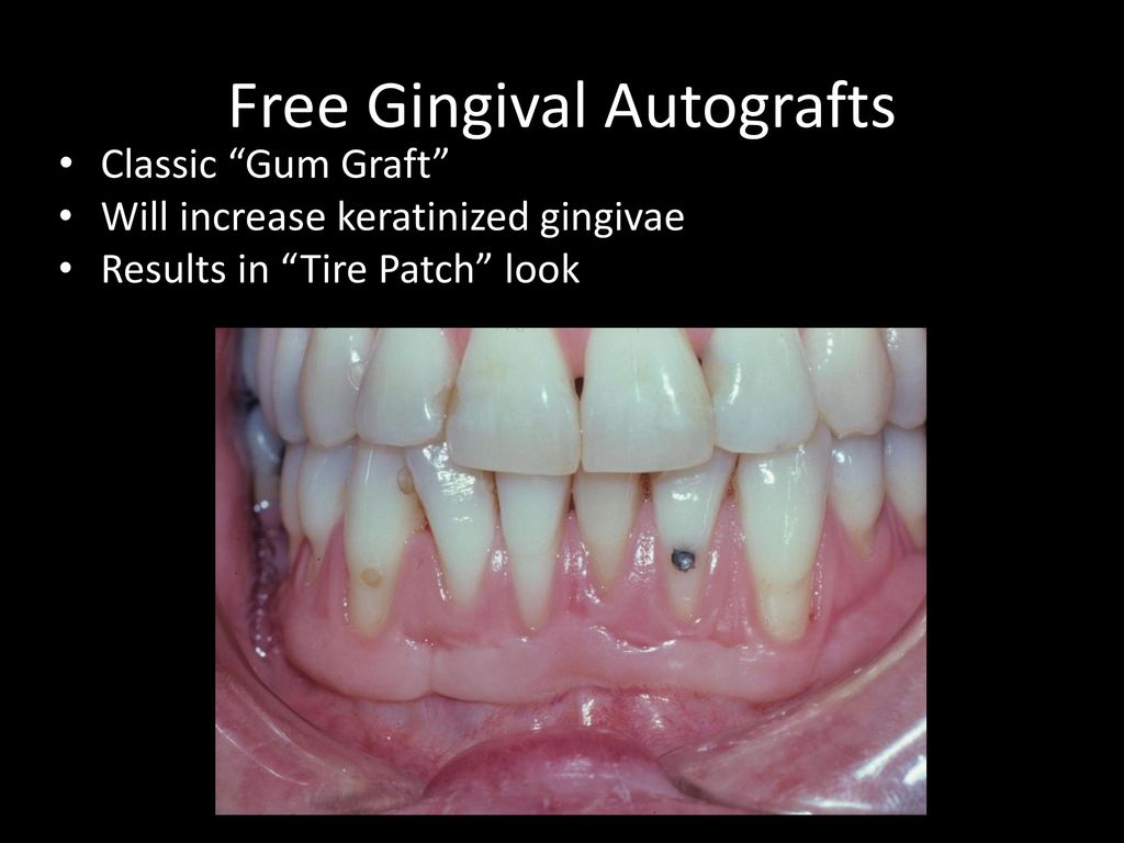 Classic "Gum Graft". 