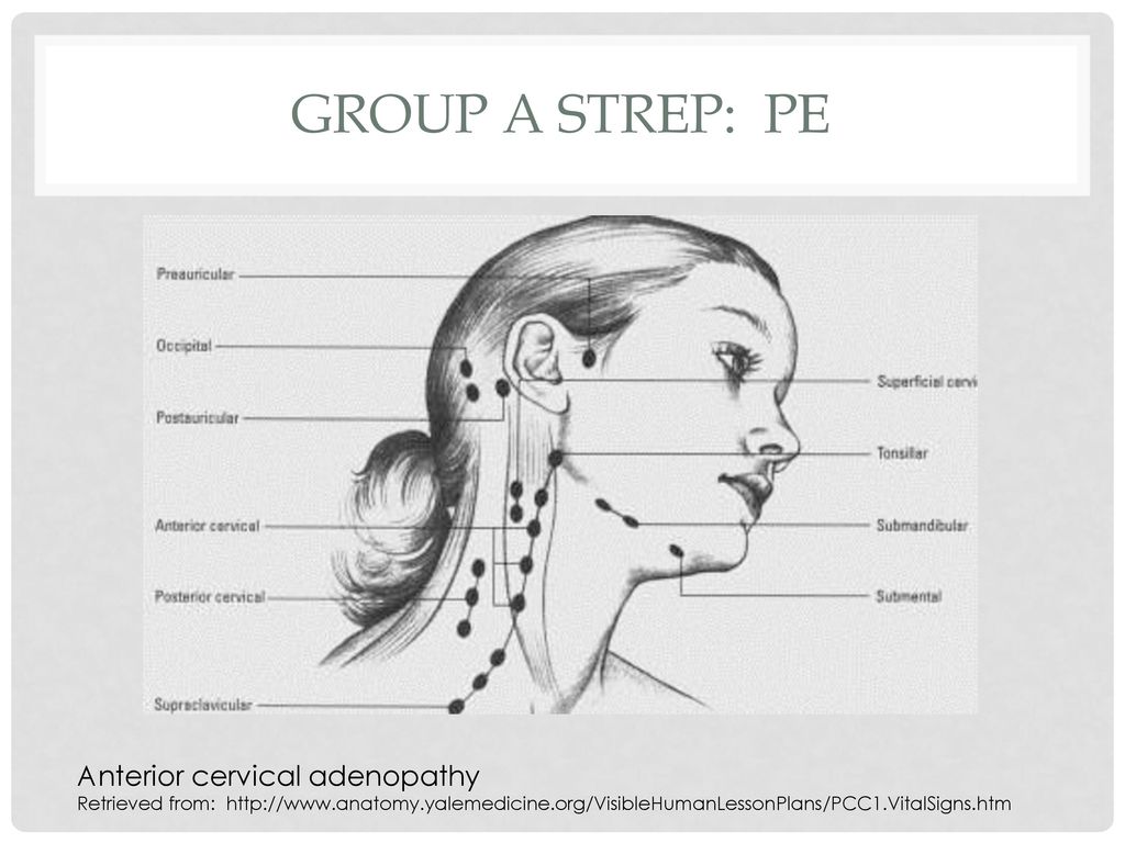 Group A strep: PE Anterior cervical adenopathy