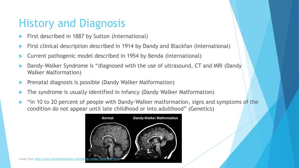 Dandy-Walker Syndrome - ppt download
