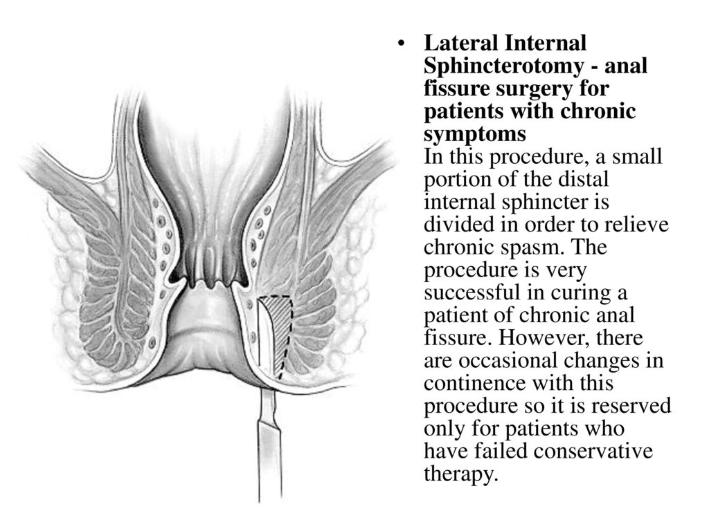 Anal Fissure. - ppt download