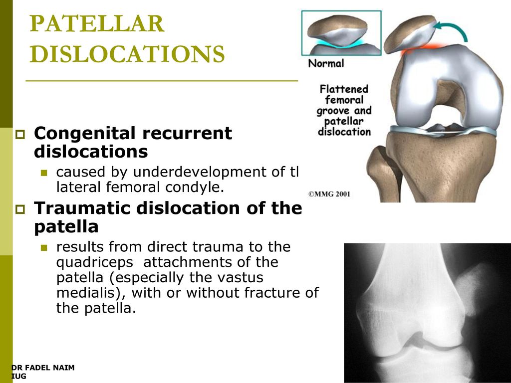 Traumatic dislocation of the patella. results from direct trauma to the qua...