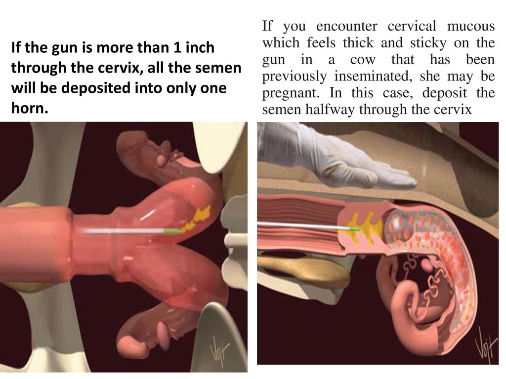 If the gun is more than 1 inch through the cervix, all the semen will be de...
