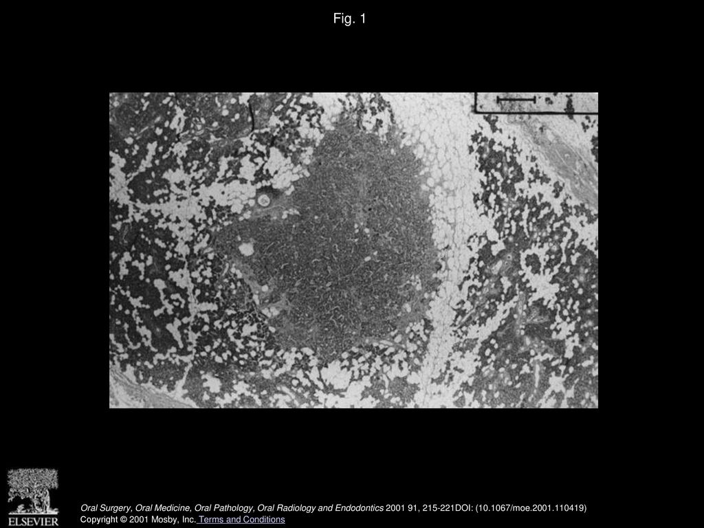 Fig. 1 One salivary gland lobule showing adenomatous ductal proliferation (hematoxylin-eosin, original magnification ×32).