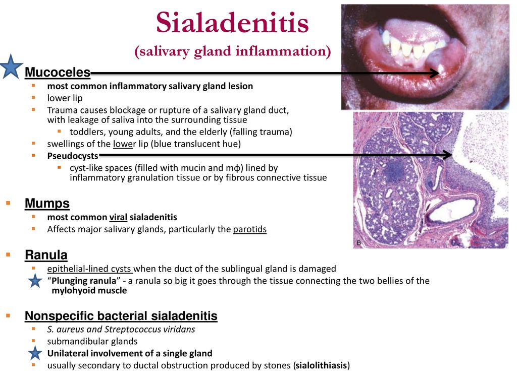 Sialadenitis Sublingual 