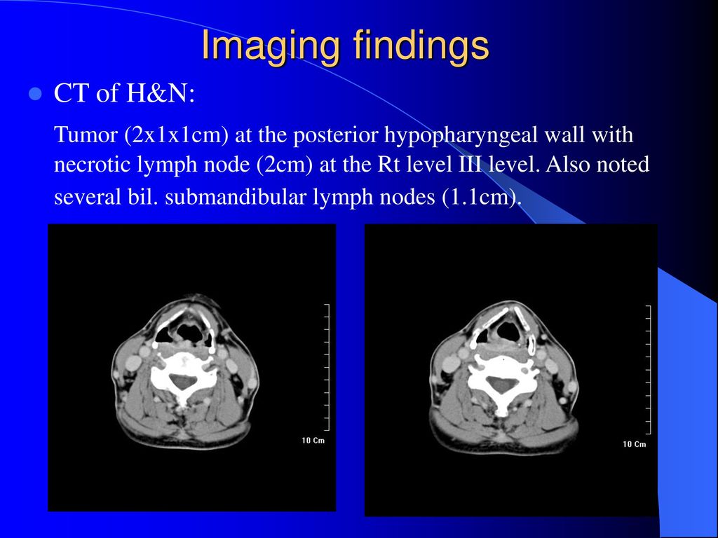 Imaging findings CT of H&N: