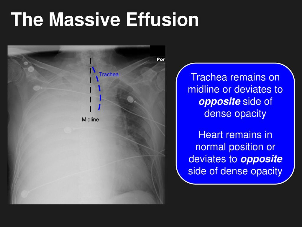 The Massive Effusion Trachea remains on midline or deviates to opposite side of dense opacity.