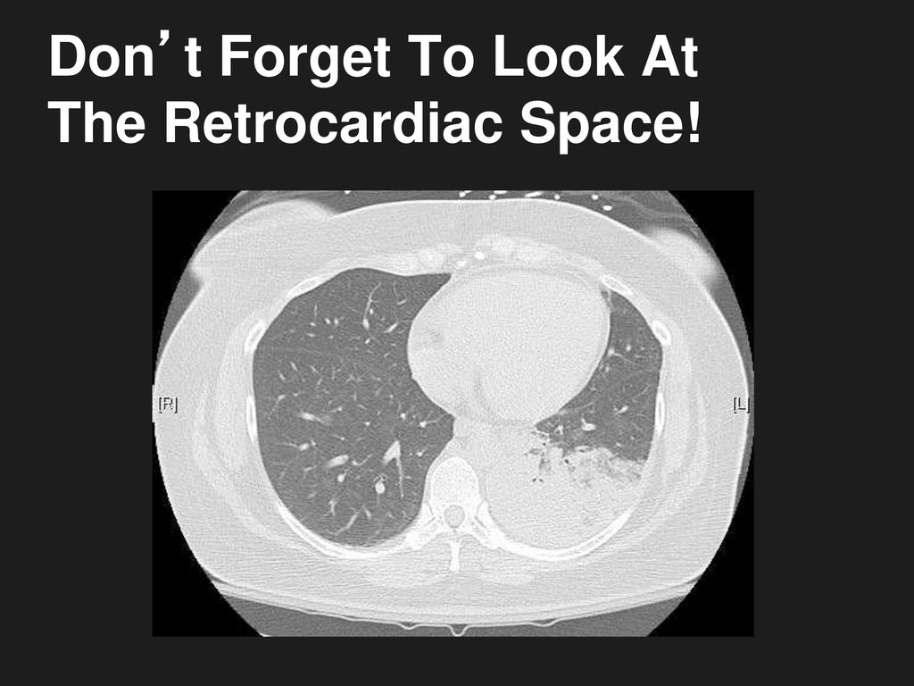 Don’t Forget To Look At The Retrocardiac Space!