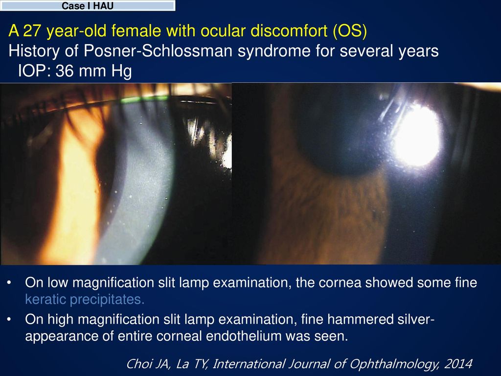 Uveitic Glaucoma Hypertensive Anterior Uveitis Ppt Download