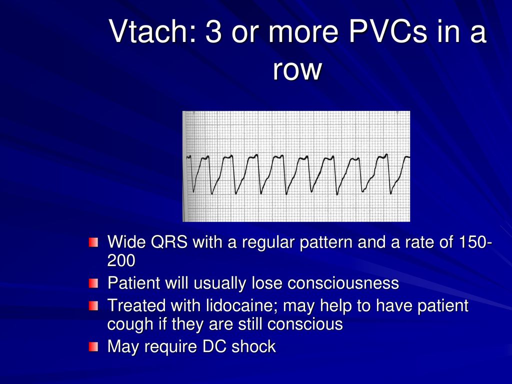 Arrhythmia and devices in hf ppt download