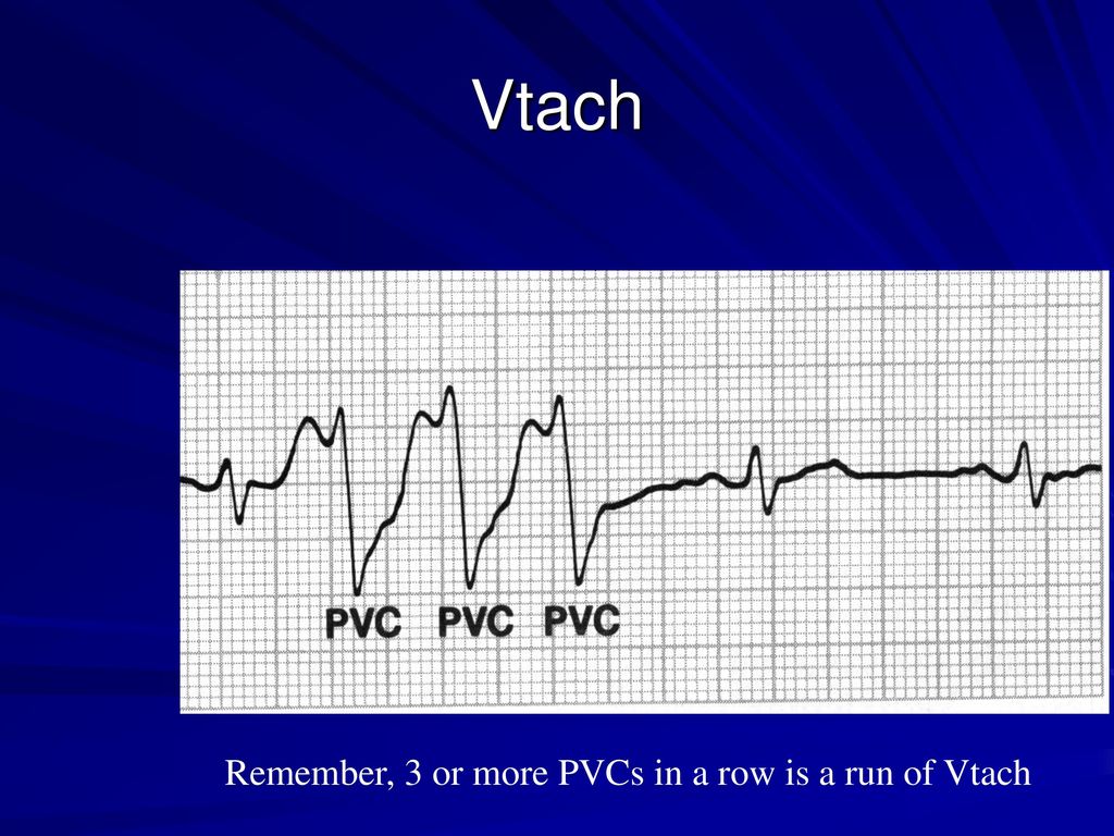 Arrhythmia and devices in hf ppt download