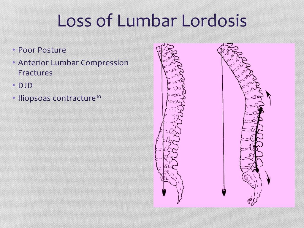 Loss of Lumbar Lordosis.