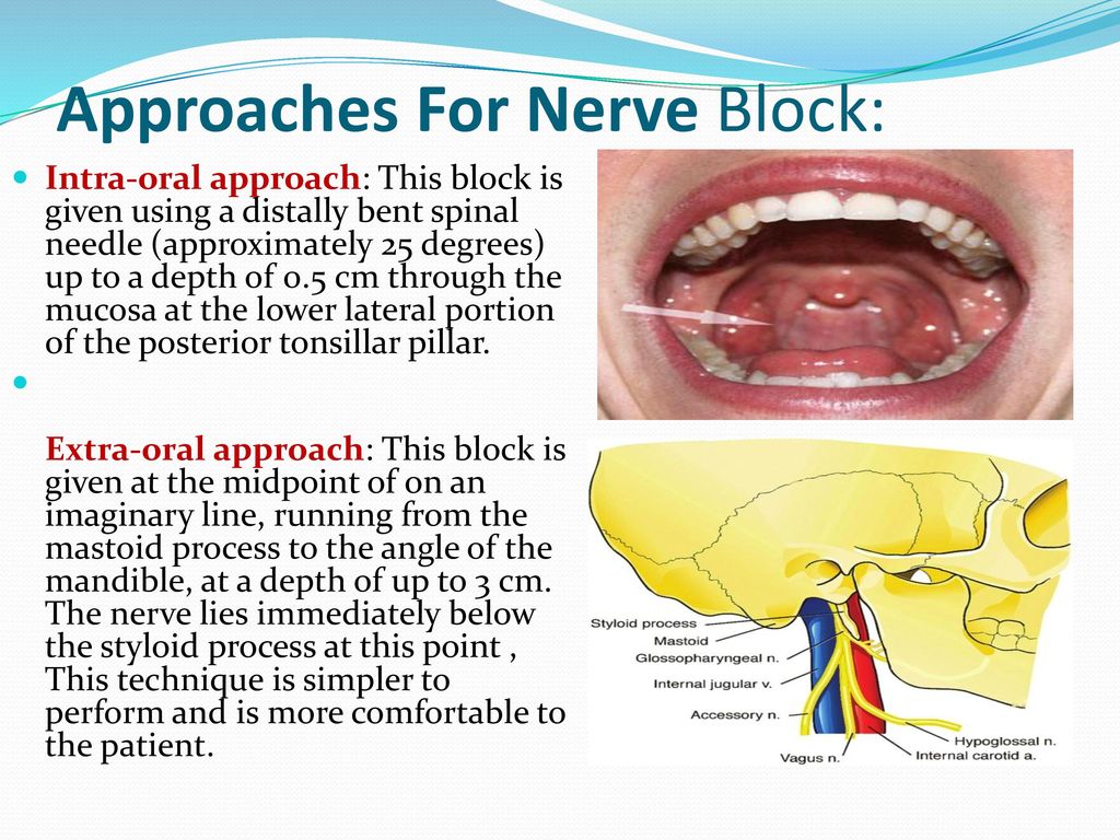 Approaches For Nerve Block: