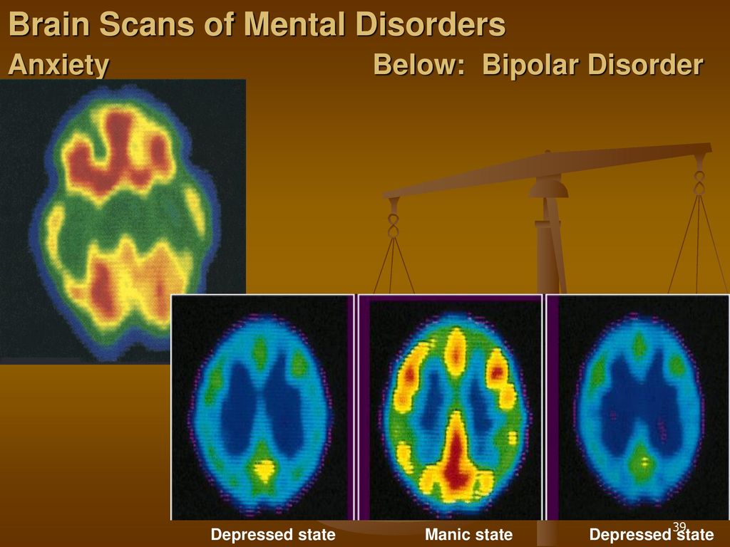 Brain disorder. The Bipolar Brain. Anxiety Brain scans. HPPD Тип 2. OCD DSM IV TM.