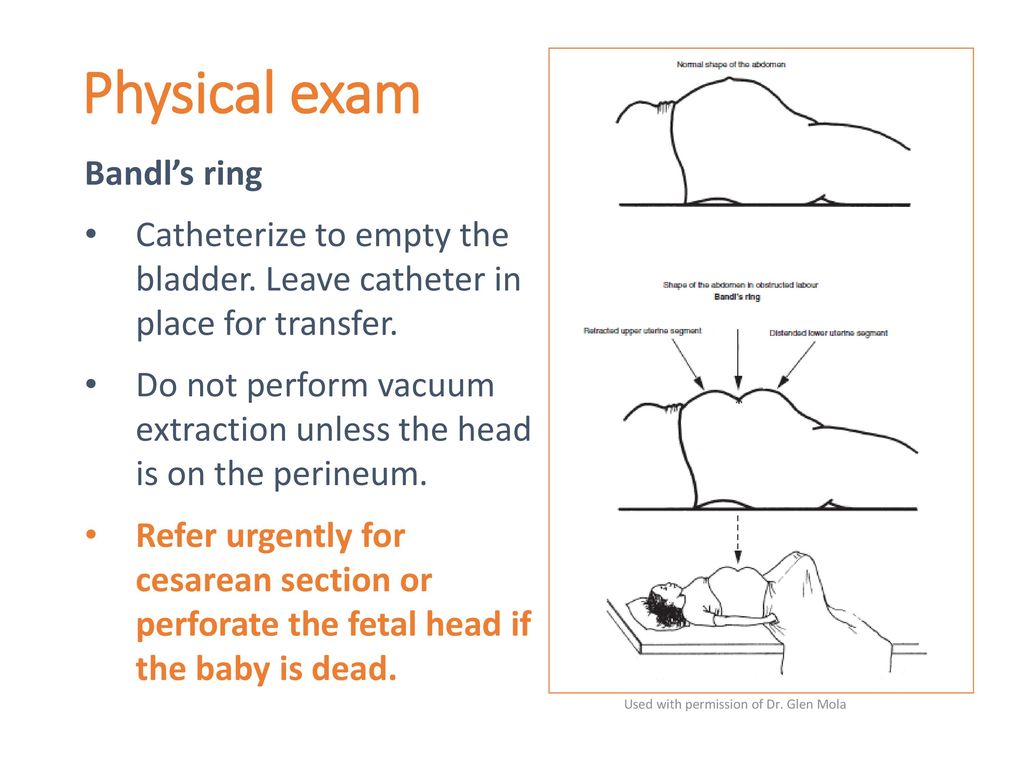 Stock Pregnancy / Delivery: Bandl's Ring — Illustrated Verdict