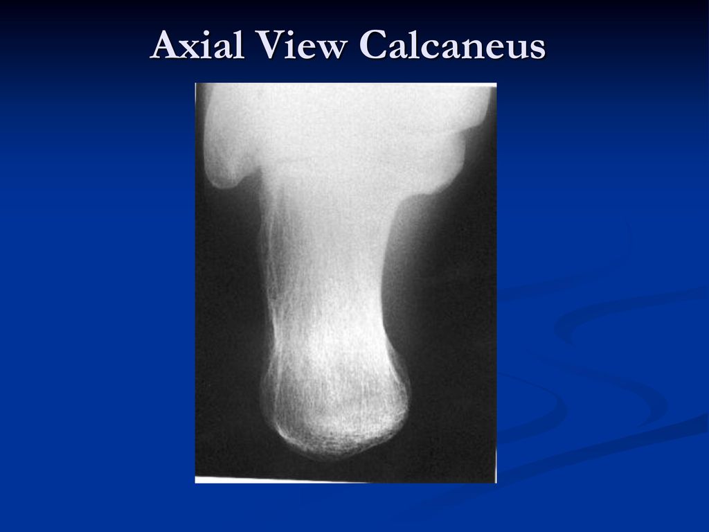 Xray Image Of Broken Calcaneus Lateral And Axial View Stock Photo -  Download Image Now - iStock