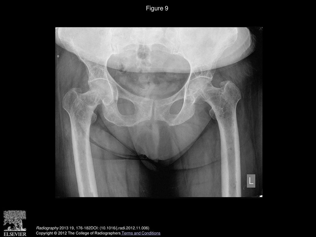 Figure 9 Radiograph of the pelvis demonstrating lytic lesions in both femora. Radiography , DOI: ( /j.radi )