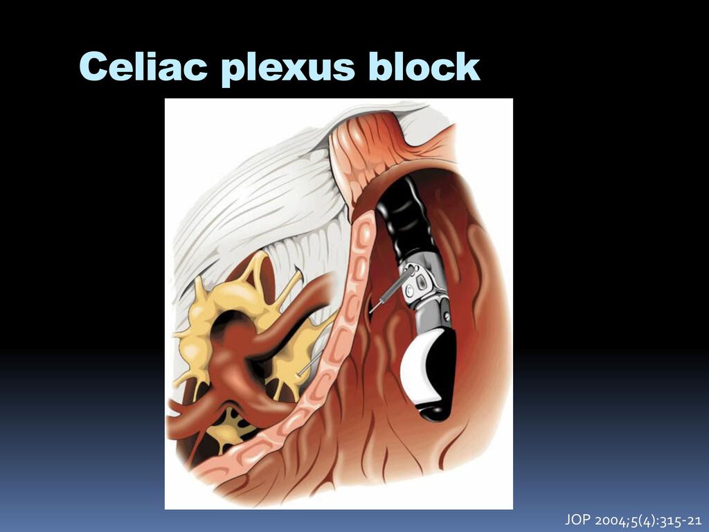 Celiac plexus block. 
