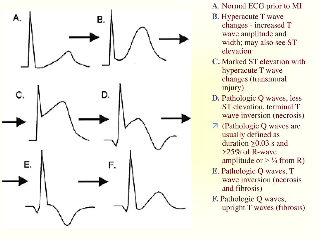 A. Normal ECG prior to MI B. Hyperacute T wave changes - increased T wave amplitude and width; may also see ST elevation.