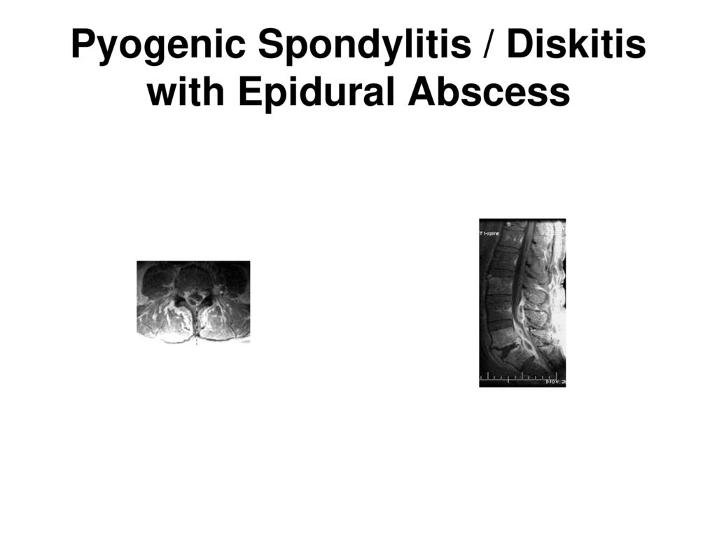 Pyogenic Spondylitis / Diskitis with Epidural Abscess