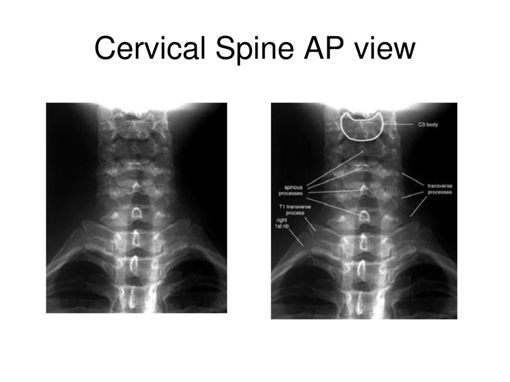 Cervical Spine AP view