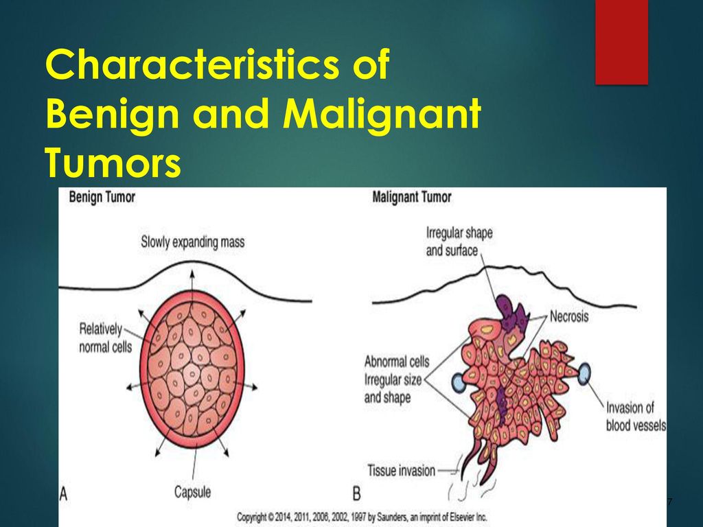 Chapter 20 Neoplasms And Cancer Ppt Download
