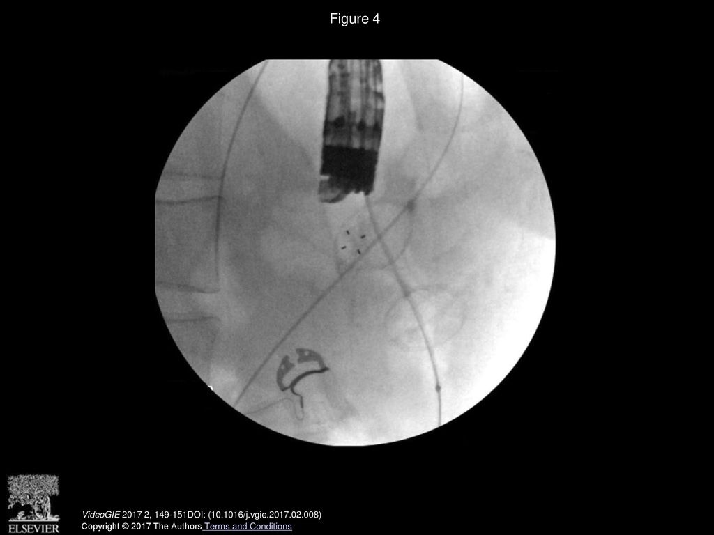 Figure 4 Fluoroscopic image of AXIOS stent with wire passage through stricture. VideoGIE , DOI: ( /j.vgie )