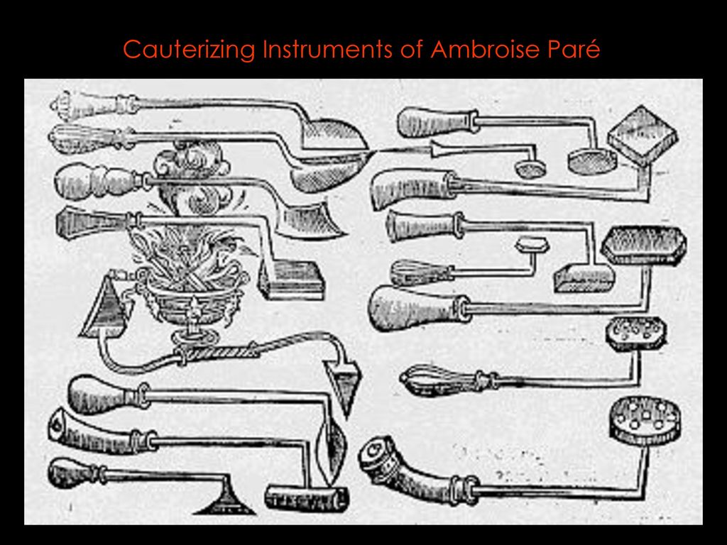 Cauterizing Instruments of Ambroise Paré