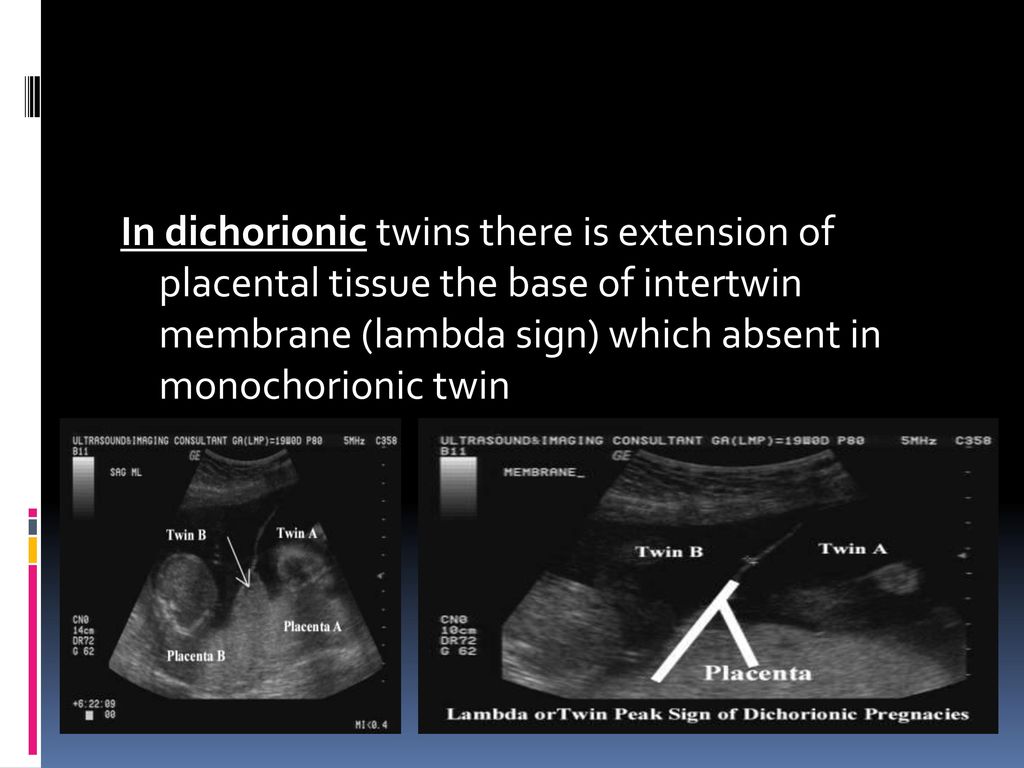 In dichorionic twins there is extension of placental tissue the base of intertwin membrane (lambda sign) which absent in monochorionic twin