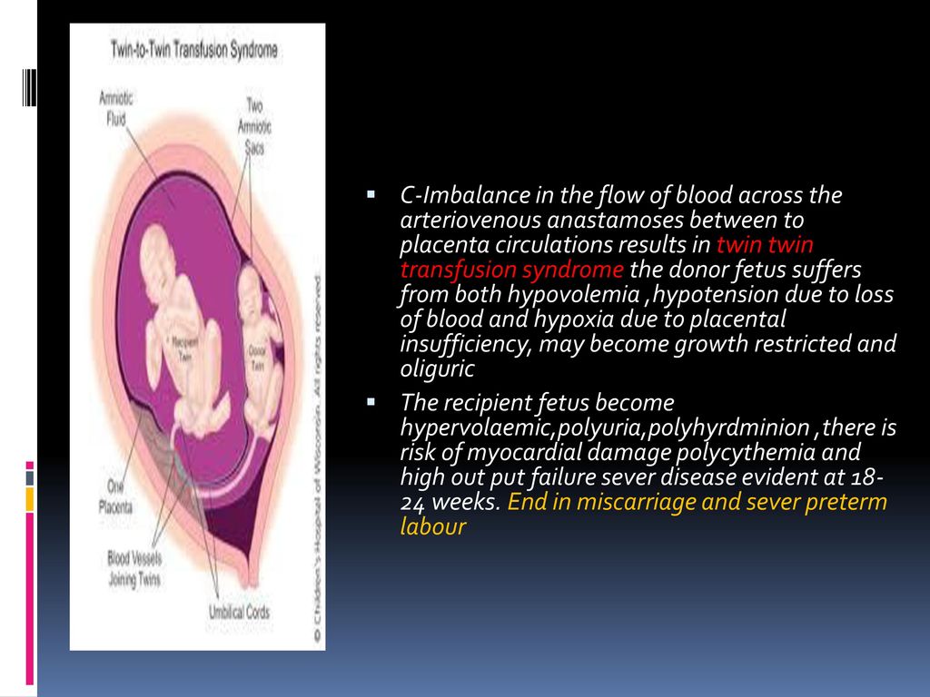 C-Imbalance in the flow of blood across the arteriovenous anastamoses between to placenta circulations results in twin twin transfusion syndrome the donor fetus suffers from both hypovolemia ,hypotension due to loss of blood and hypoxia due to placental insufficiency, may become growth restricted and oliguric