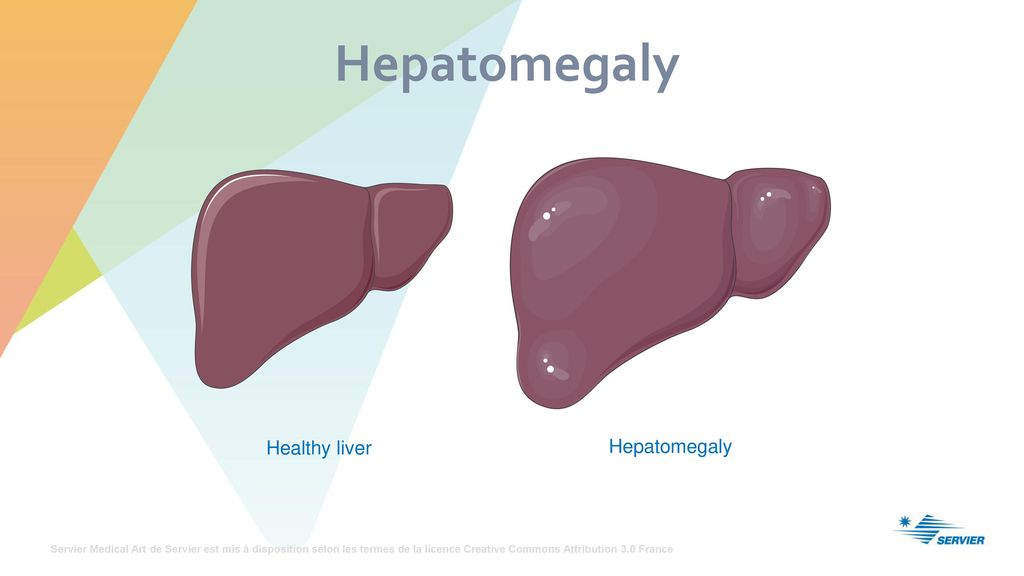 Hepatomegaly Healthy liver Hepatomegaly