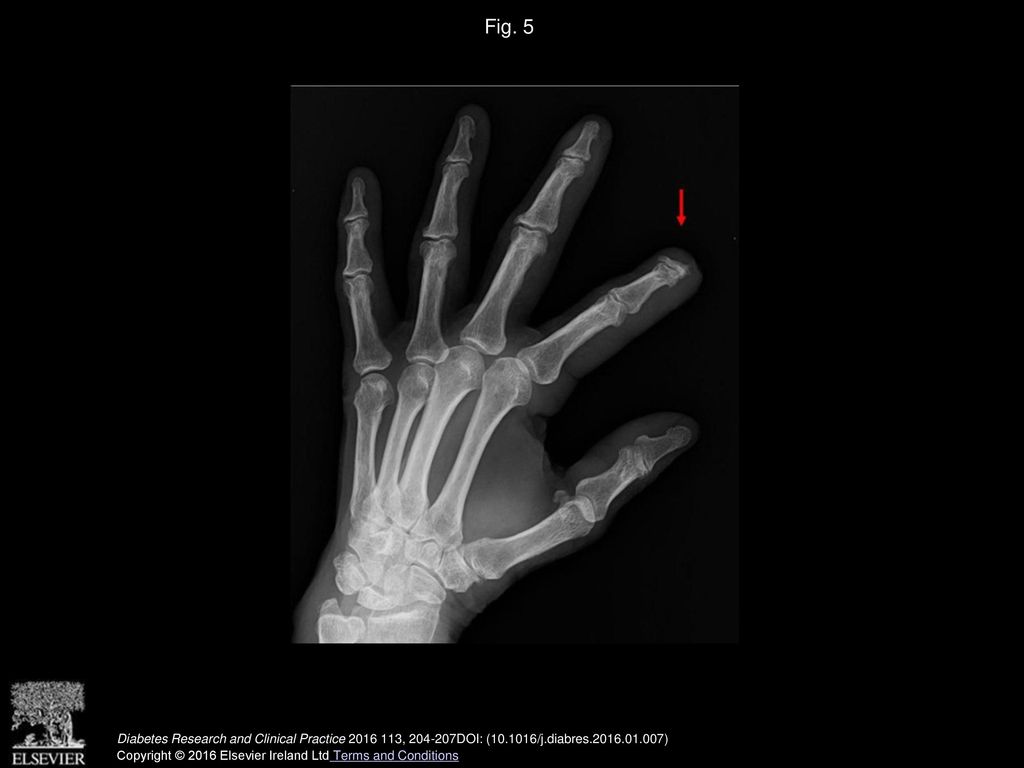 Fig. 5 Acro-osteolysis and bone resorption on the second finger of left hand.
