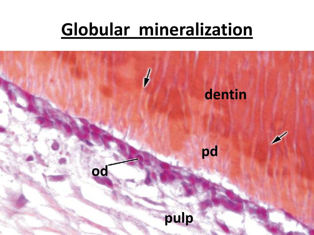 Globular mineralization