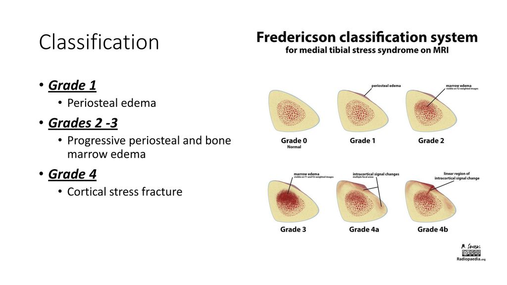 Medial Tibial Stress Syndrome Shin Splints Ppt Download