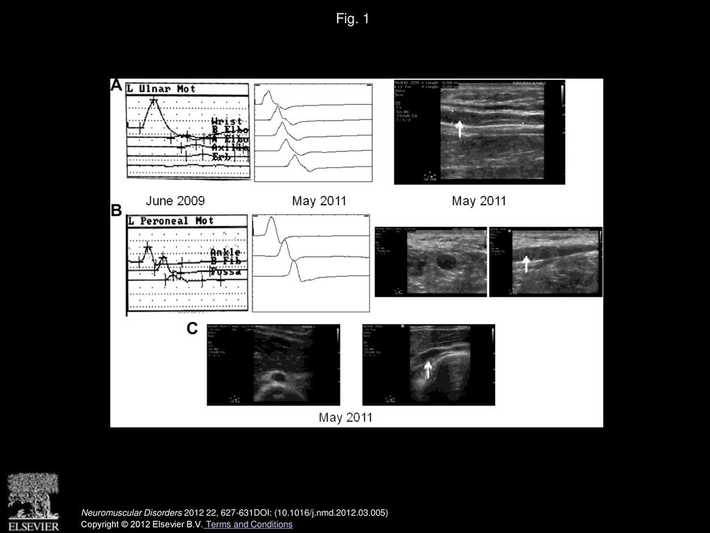 Ultrasonography of MADSAM neuropathy: Focal nerve enlargements at sites ...