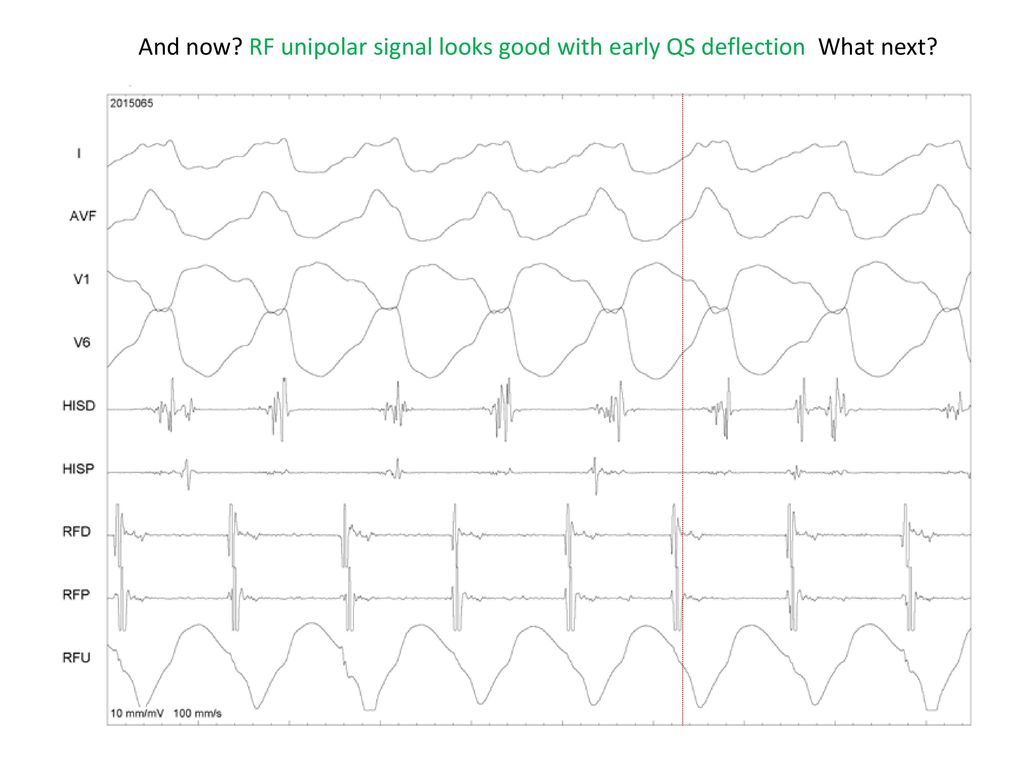 And now RF unipolar signal looks good with early QS deflection What next