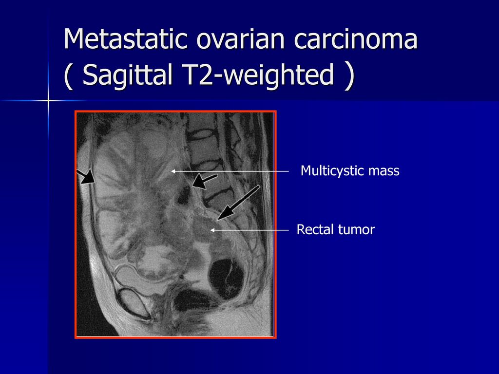 Developing An Mr Imaging Strategy For Diagnosis Of Ovarian Masses Ppt