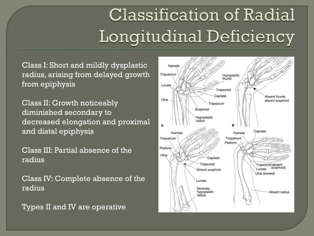 Radial Longitudinal Deficiency (Radial Club Hand)