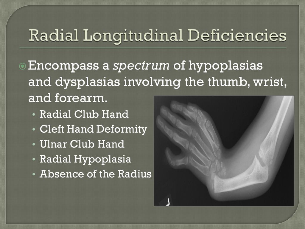 RADIAL LONGITUDINAL DEFICIENCY: Treatment and Emerging Techniques - ppt  download