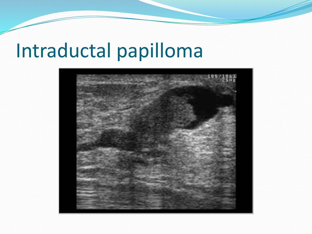intraductalis papilloma orvos uk