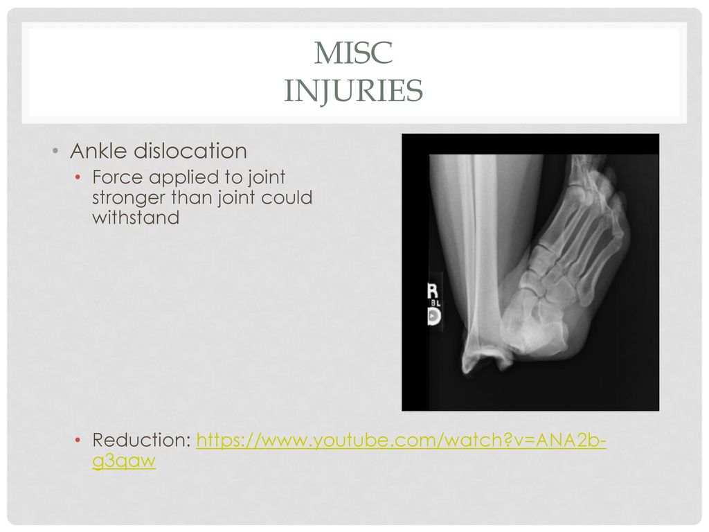 Misc Injuries Ankle dislocation
