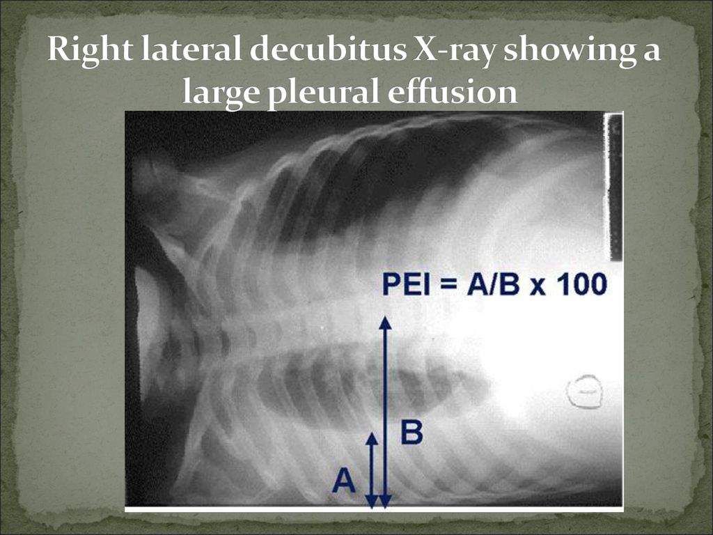 Right lateral decubitus X-ray showing a large pleural effusion