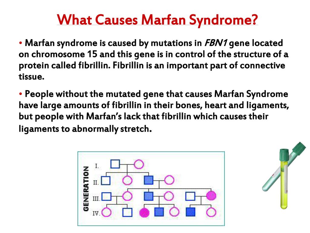 marfan syndrome melanie dragomire dr. williams ns ppt download
