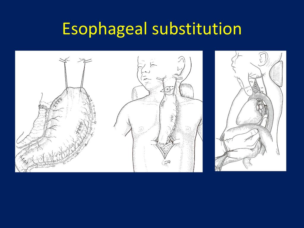 Esophageal Reconstruction - ppt download