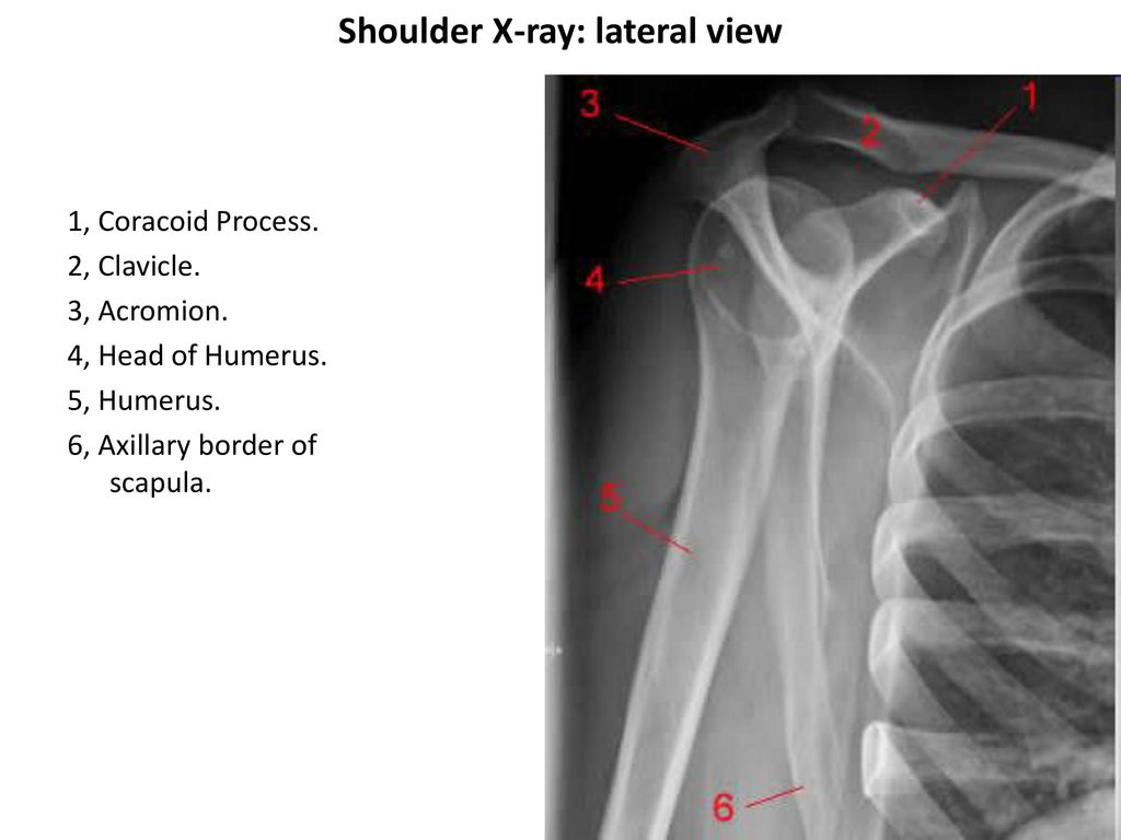 Shoulder X-ray: lateral view.