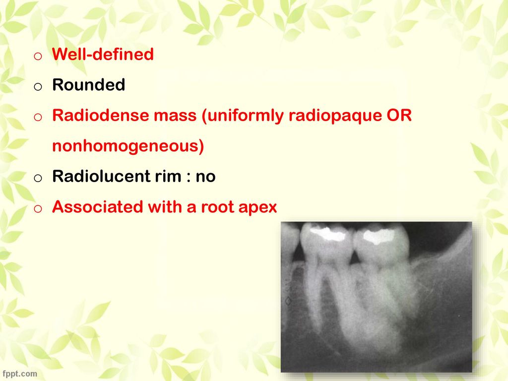 Well-defined Rounded. Radiodense mass (uniformly radiopaque OR nonhomogeneous) Radiolucent rim : no.