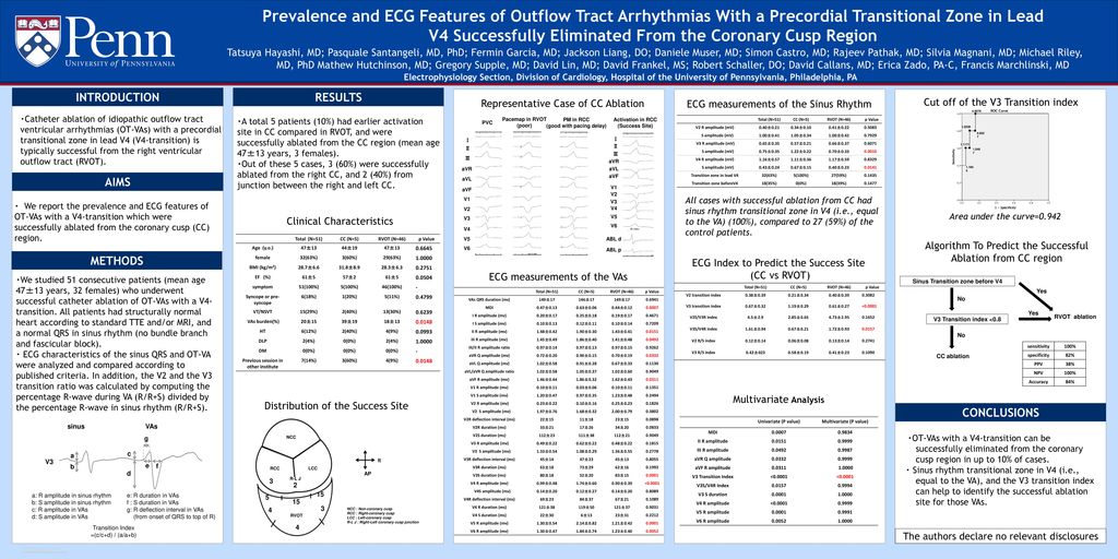 Prevalence and ECG Features of Outflow Tract Arrhythmias With a Precordial Transitional Zone in Lead V4 Successfully Eliminated From the Coronary Cusp Region