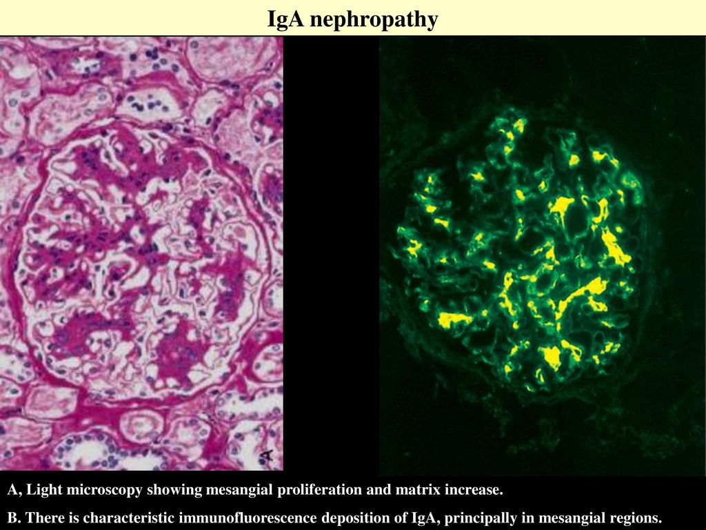 IgA nephropathy A, Light microscopy showing mesangial proliferation and matrix increase.