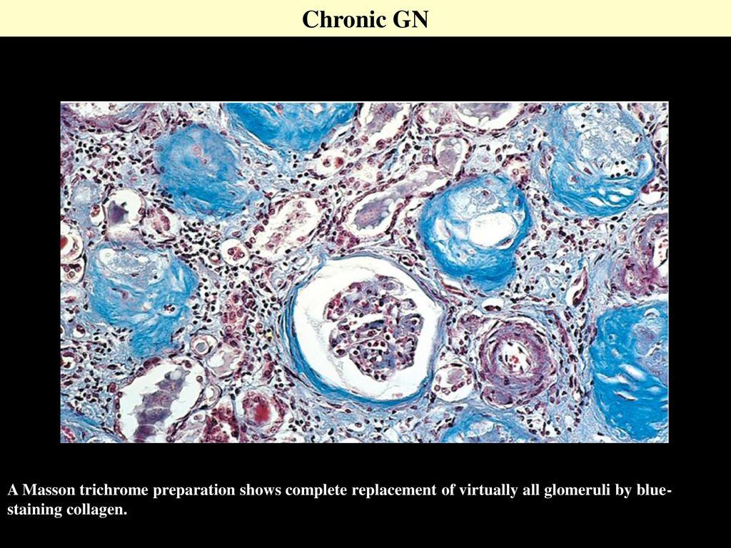 Chronic GN A Masson trichrome preparation shows complete replacement of virtually all glomeruli by blue-staining collagen.
