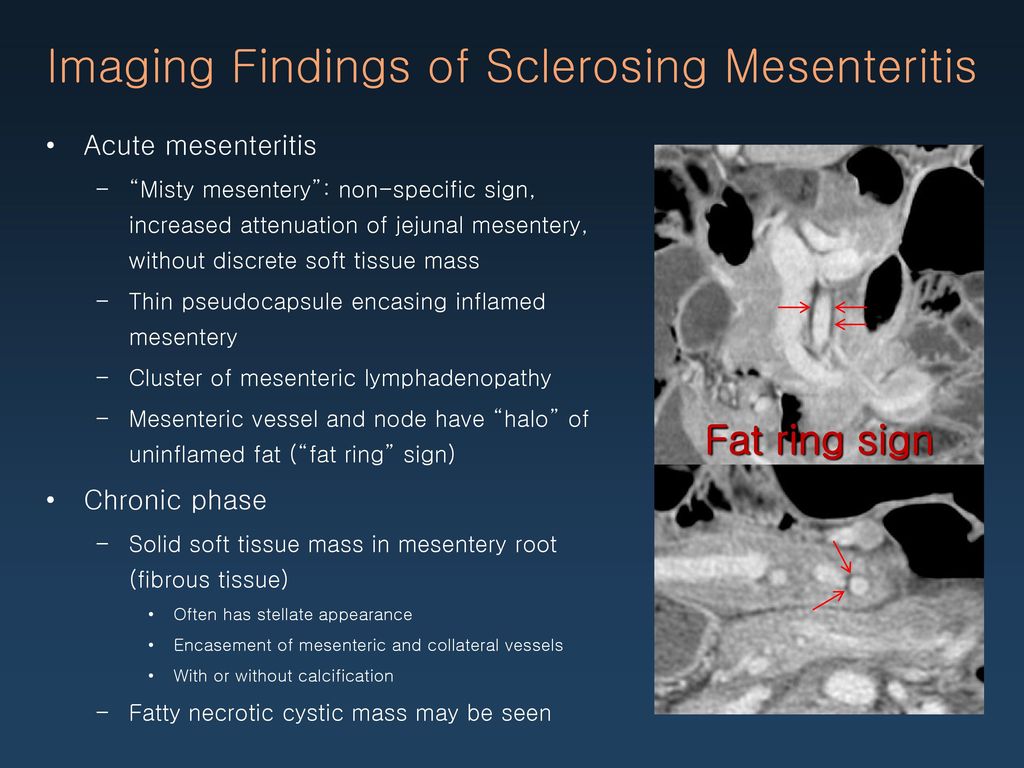 Imaging+Findings+of+Sclerosing+Mesenteritis