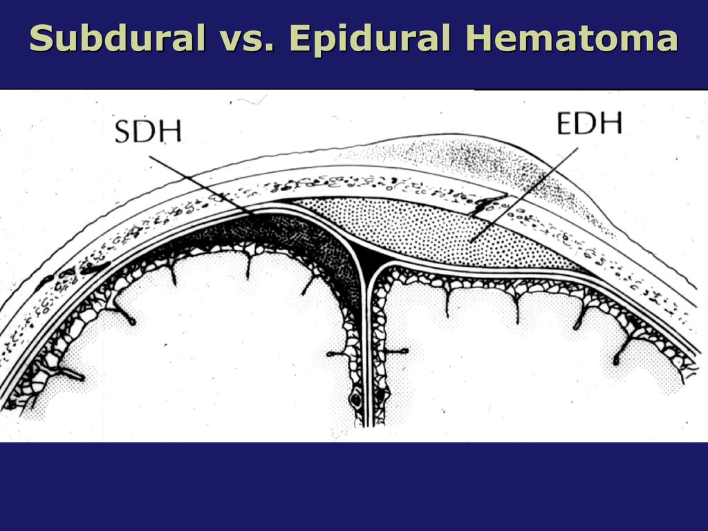 Subdural vs. Epidural Hematoma.